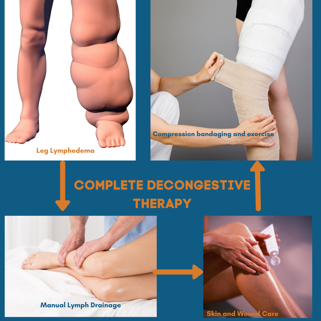 Lymphedema Portland Therapy